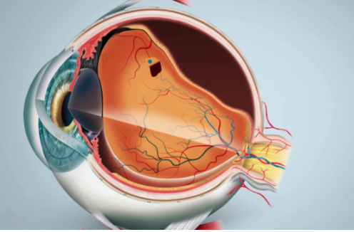 Você está visualizando atualmente DESCOLAMENTO DE RETINA